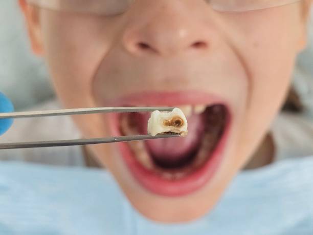Best Dentist for Tooth Abscess  in Percy, IL